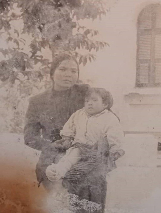 Chân phải của chị Hằng bị chẩn đoán u xương khi chị mới 3 tuổi